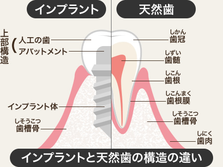 インプラントと天然歯の構造の違い