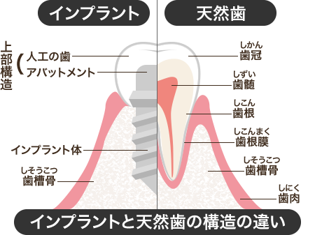 インプラントと天然歯の構造の違い