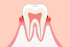 歯茎 が 痒い