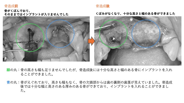 GBRの歯科インプラントへの応用 GBR法（骨を増やす方法） - 医療法人さかの歯科