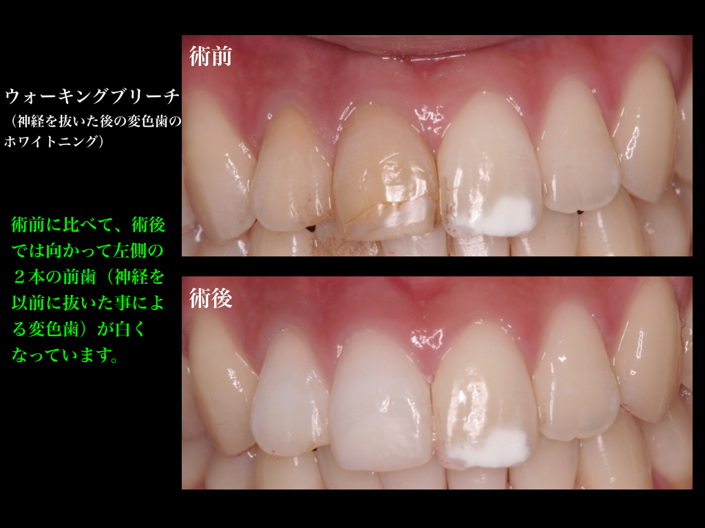 神経 の ない 歯 白く したい 料金