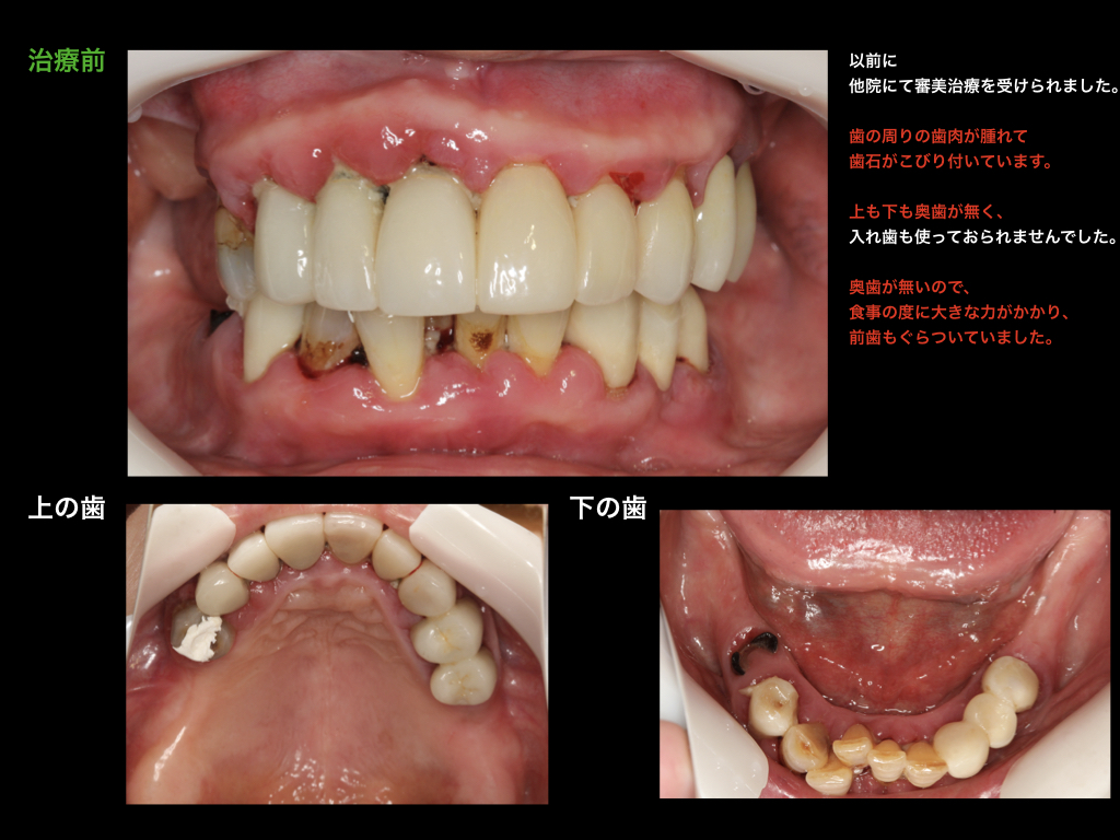 歯茎 奥歯 腫れ の